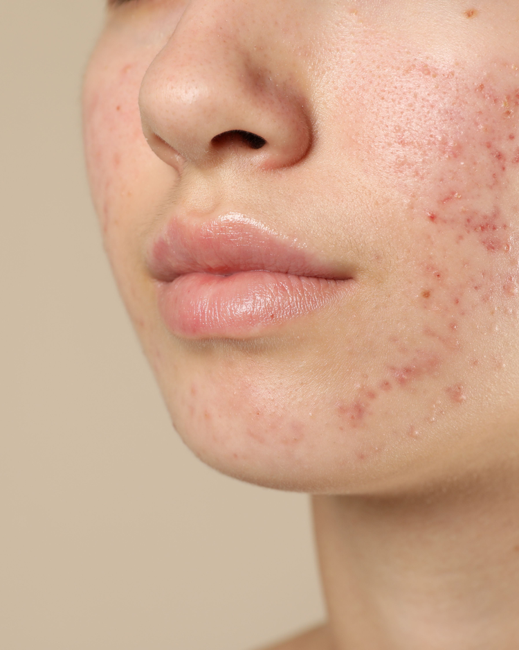Acne